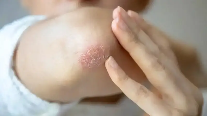 湿疹不敢吃鸡蛋?医生告诫:不想病情反复,这4种食物要忌口