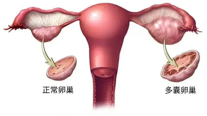 终于改名!这个病困扰全球1.7亿女性,却被“叫错”90年