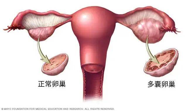 终于改名！这个病困扰全球1.7亿女性，却被“叫错”90年