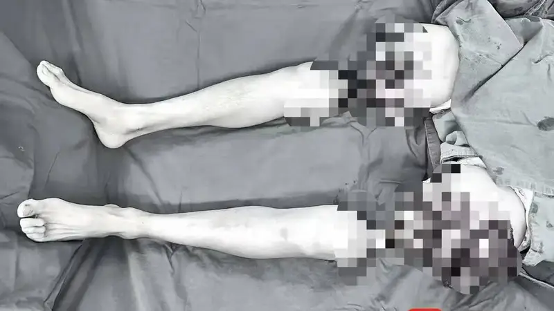 男子双大腿被绞断完全分离,经手术重新“接”回