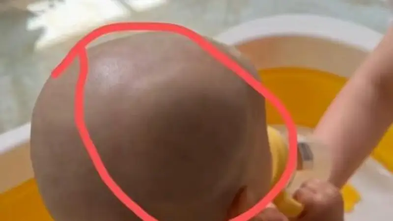宝宝从餐椅跌落,家中老人不敢告知孩子父母,两天后孩子确诊头骨骨折