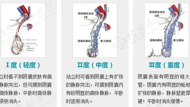 备孕两年无果,28岁杭州男子傻眼:这里竟藏了一窝“蚯蚓”!医生:千万别小看了