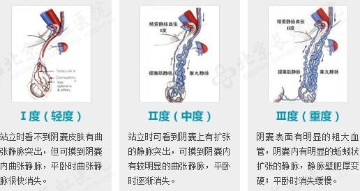 备孕两年无果,28岁杭州男子傻眼:这里竟藏了一窝“蚯蚓”!医生:千万别小看了